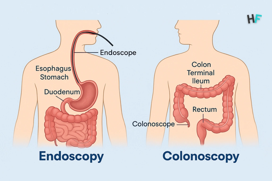 What is Colonoscopy