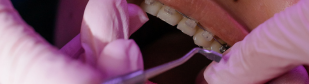 How Do Orthodontists Pull Teeth?