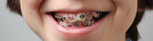 Can You Eat Dumplings With Braces?