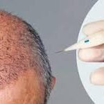 DHI (Direct Hair Implant) in Dubai
