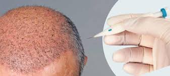 DHI (Direct Hair Implant) in Dubai