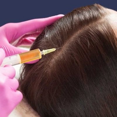 GFC Hair loss in Dubai UAE