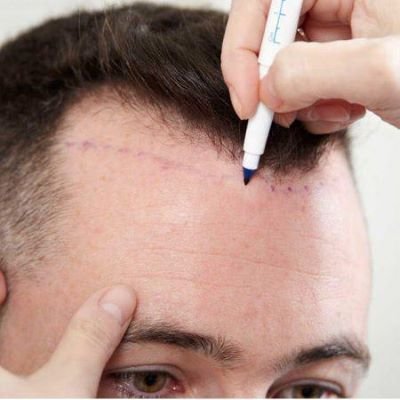 GFC Hair Loss in Dubai UAE At Glamorous Clinic