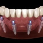 Dental Implantologist UAE