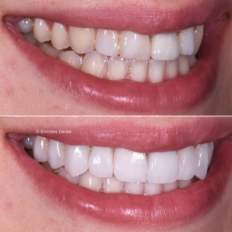 Emirates Dental – Cosmetic Dentistry & Invisalign Clinic Dubai