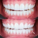 Hollywood smile – Veneers in Dubai