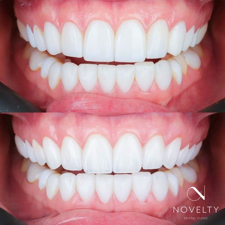 Hollywood smile – Veneers in Dubai