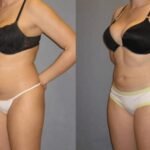 Novomed Liposuction Center – Abu Dhabi