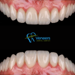 Veneers Dental Centre