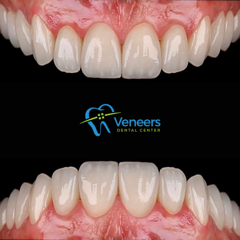 Veneers Dental Centre