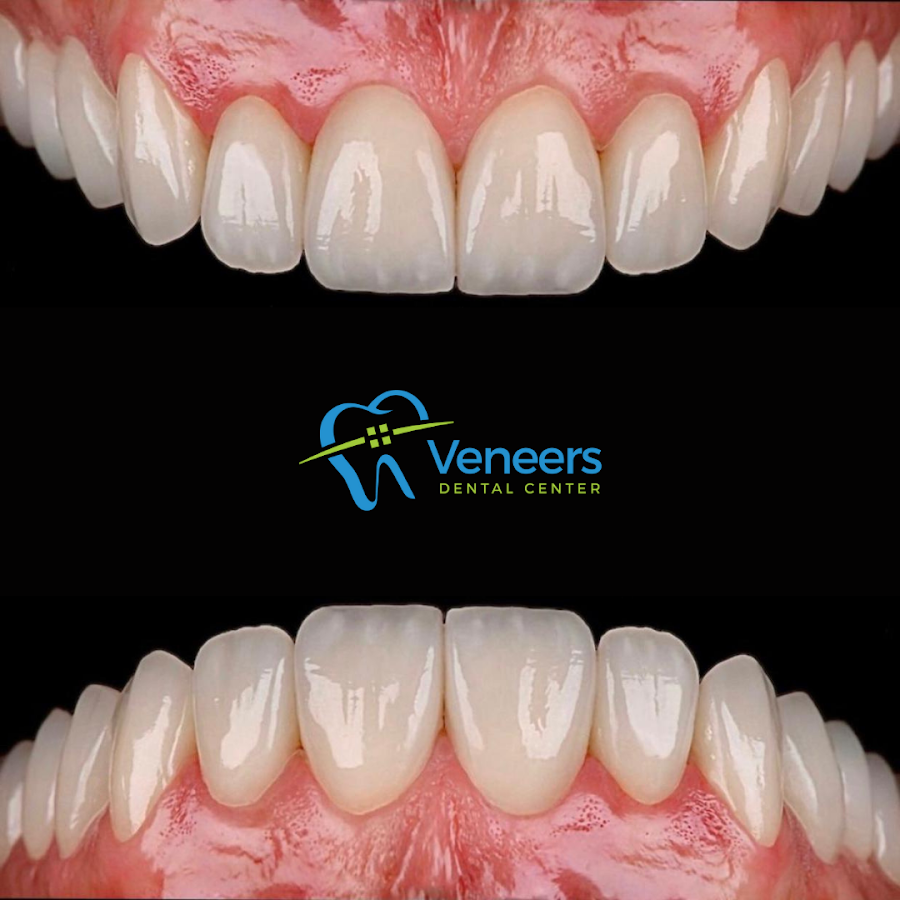 Veneers Dental Centre