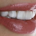 Veneers Dubai – Hollywood Smile