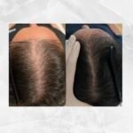 LEJOU DUBAI PRP HAIR