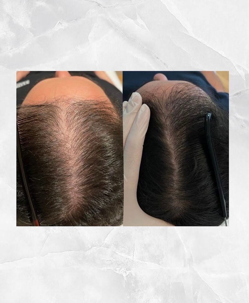 LEJOU DUBAI PRP HAIR